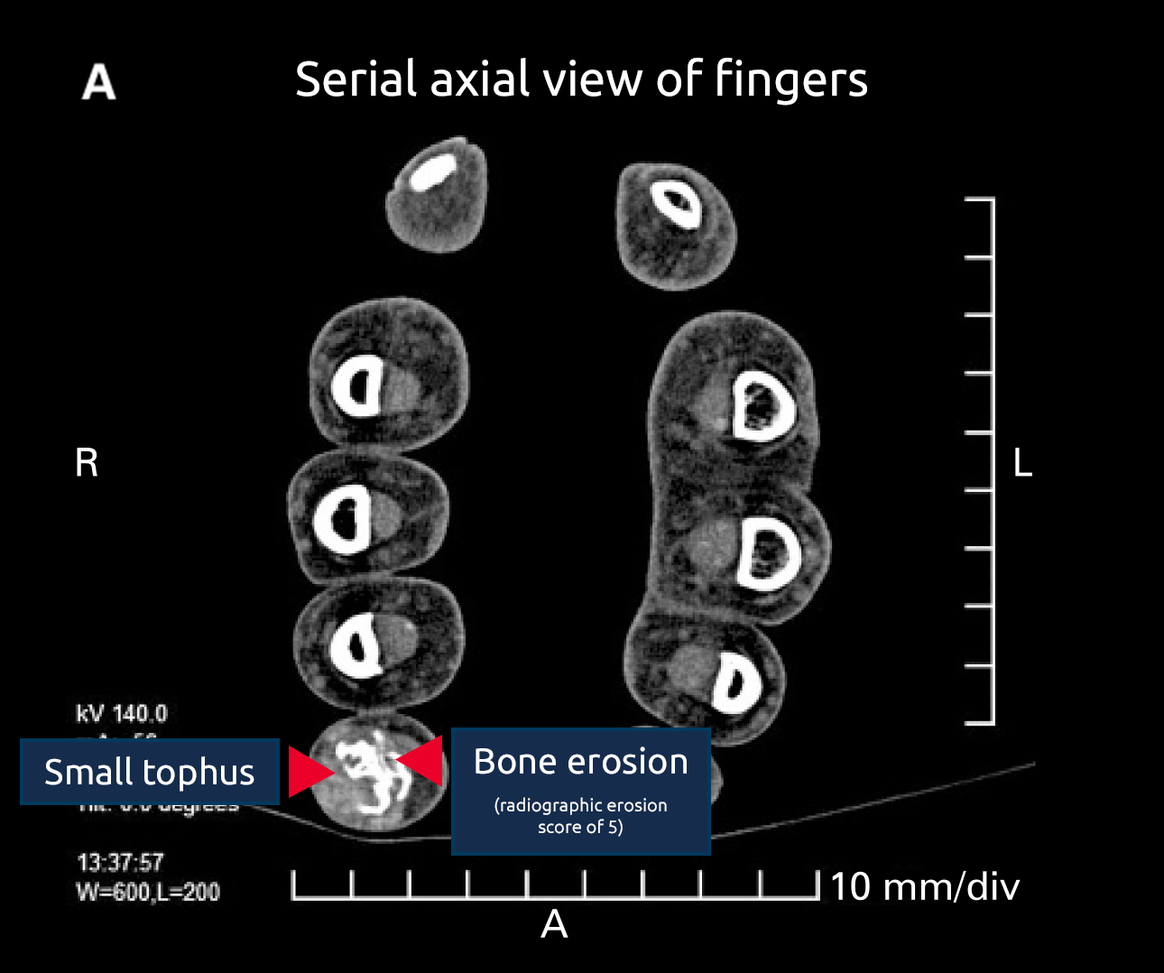 Serial axial view of fingers Small tophus Bone erosion (radiographic erosion score of 5)