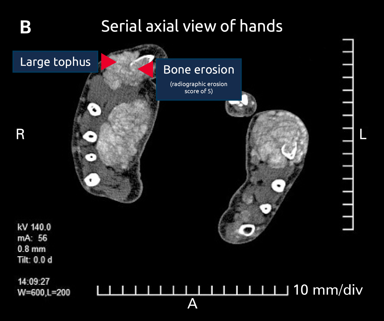 Serial axial view of hands Large tophus Bone erosion (radiographic erosion score of 5)