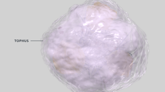 Choi DECT scan of hand