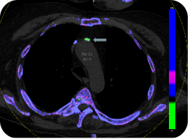 A DECT scan showing urate crystal deposition in the wall of the aortic arch in the heart of a gout patient