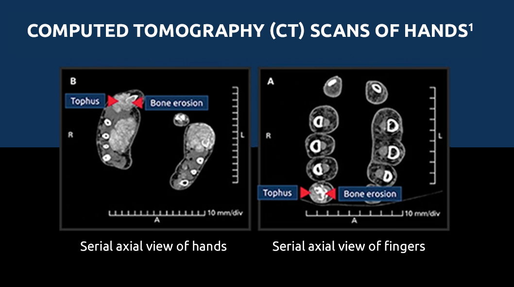CT scan showing bone erosion in gout patient's hands