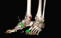 DECT scan of gout patient showing urate crystal deposits in the feet and ankles