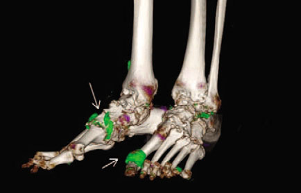 DECT scan of gout patient showing urate crystal deposits in the feet and ankles