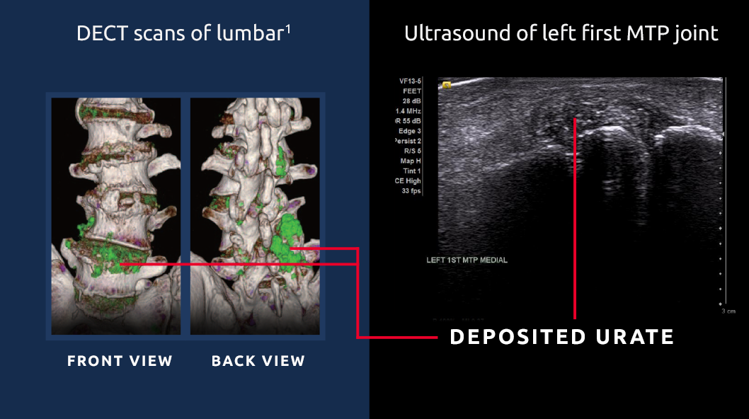 DECT scan of urate crystal deposits in lumbar spine