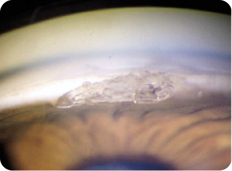 A photo of urate crystal deposits from gout on the iris and anterior chamber of the left eye