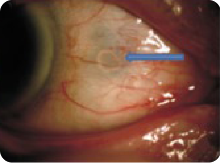 A photo of urate crystal deposits from gout in eye of patient, with an arrow pointing to the superficial sclera