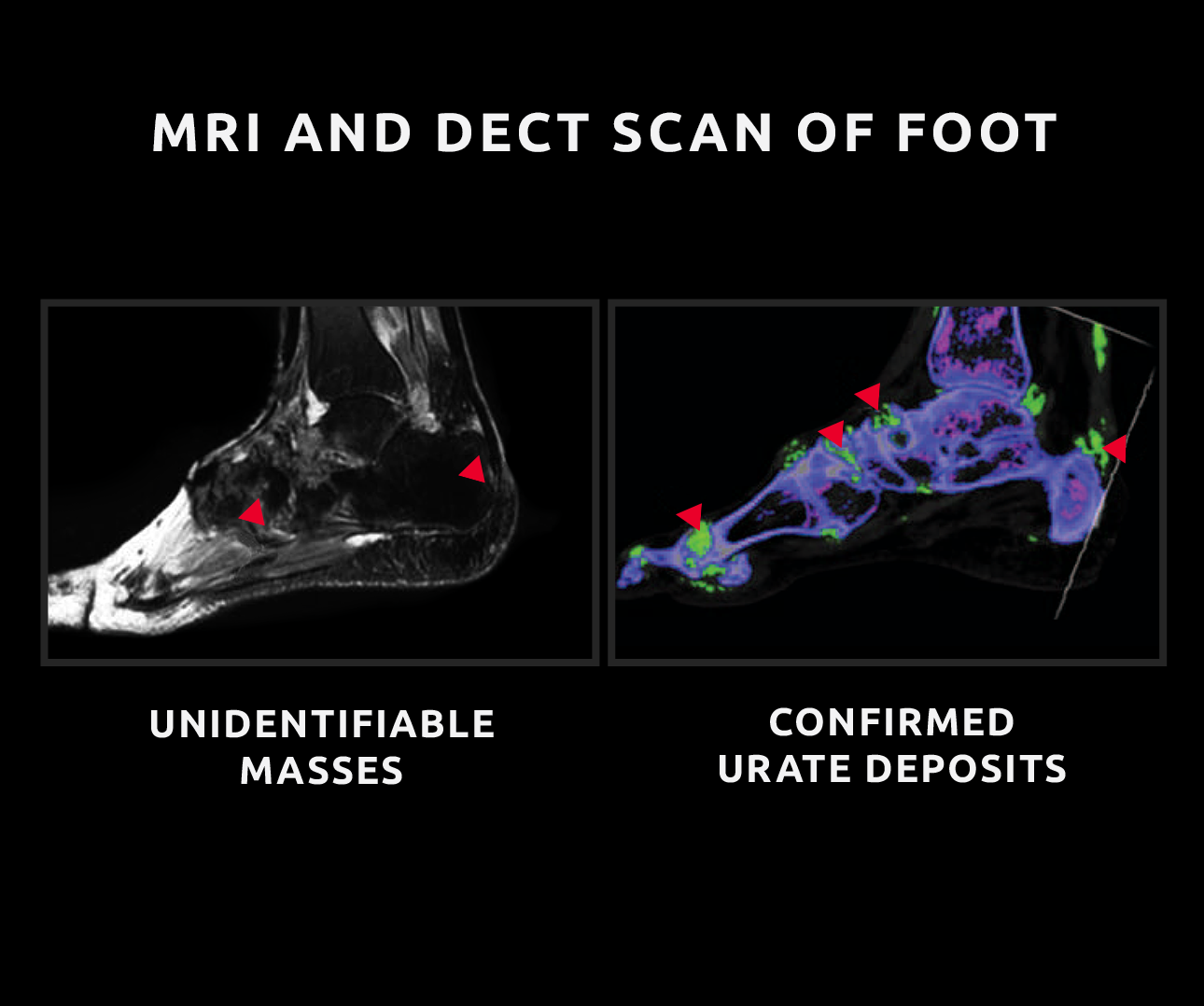 Image comparing MRI and DECT scans of foot for the detection of gouty tophi
