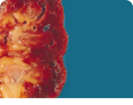 An image of renal urate deposits within the renal medulla in gout patient