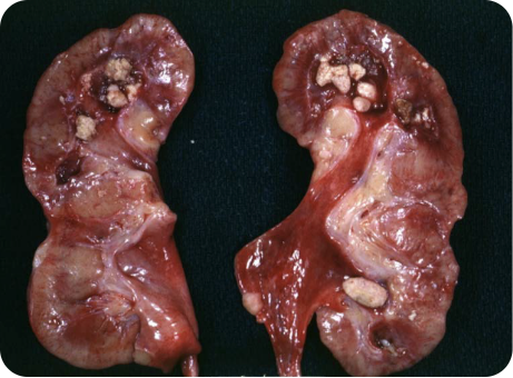 An image of renal stones in the collecting systems of the kidneys in gout patient