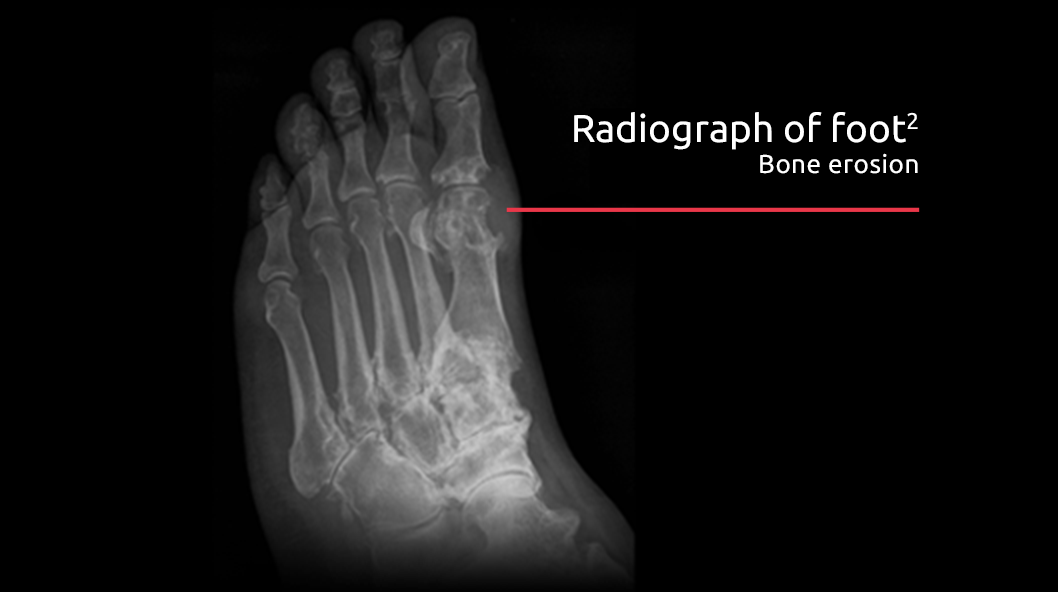 Radiograph of bone erosion in gout patient's foot