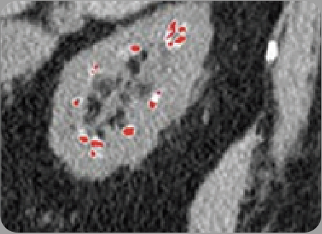 Medical imaging showing urate crystal deposition in the renal medulla of the kidneys in gout patient
