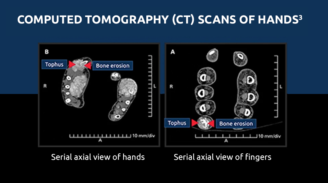 Bone erosion image