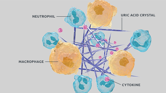 Illustration of uric acid crystals, neutrophils, macrophages, and cytokines in gout