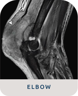 X-ray of bone erosion from gout in elbow