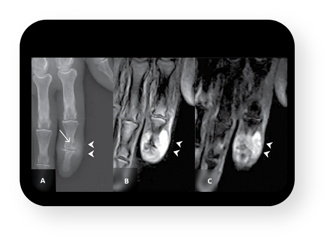 X-ray of gout patient showing urate crystal deposits in the finger